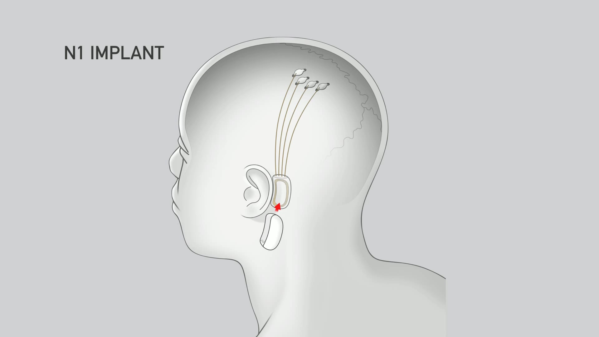O dispositivo da Neuralink será conectado atrás da orelha e o chip implantado no cérebro deve expandir o controle do cérebro pelos humanos