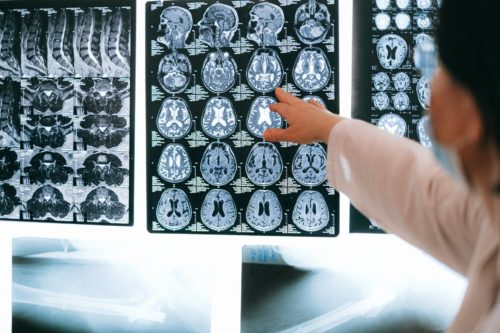 Um tratamento experimental pode ter "iniciado" os cérebros de dois pacientes que estavam em um estado minimamente consciente por meses após um coma