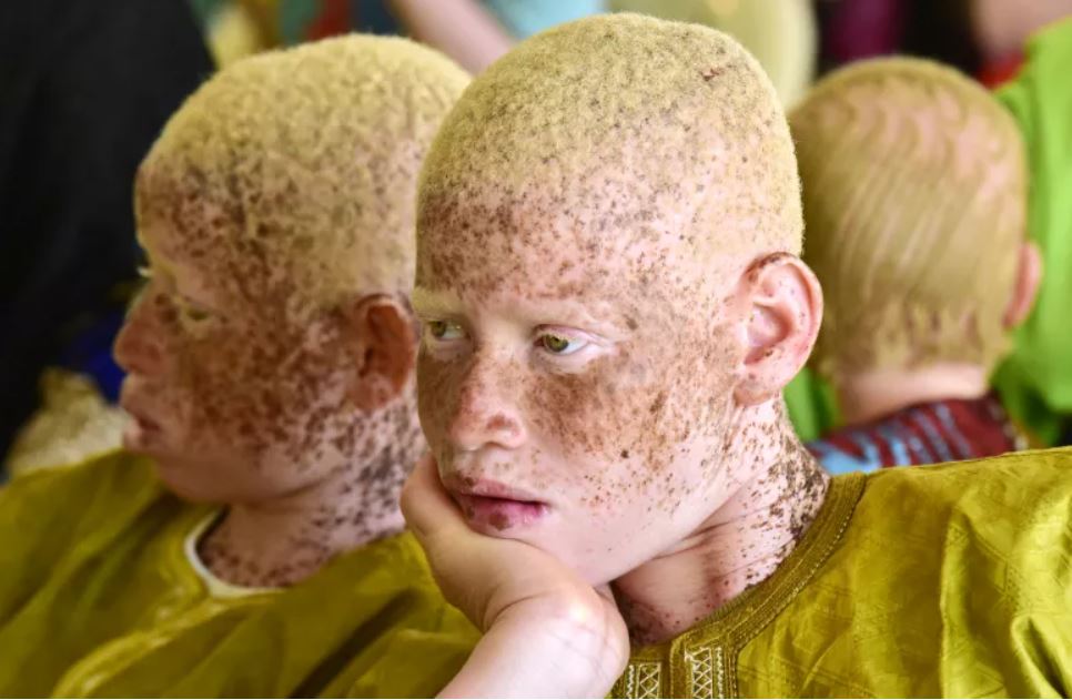 Pessoas com albinismo assassinadas ou atacadas devido à crença de que o uso das suas partes corporais em poções 'mágicas' pode trazer boa sorte e riqueza