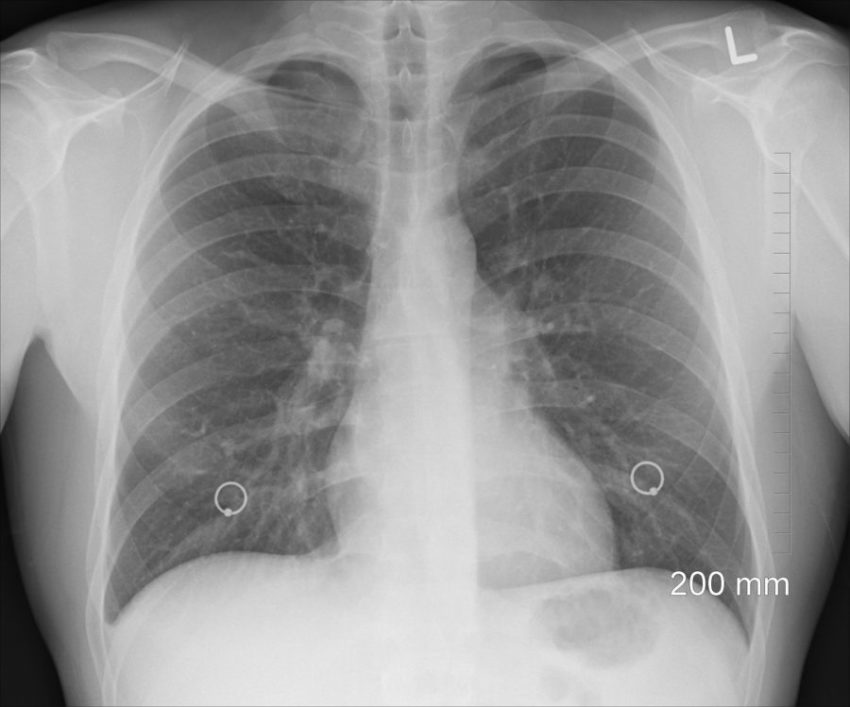 Fibrose pulmonar atinge 2% dos infectados pela covid-19, indicam dados preliminares da pesquisa