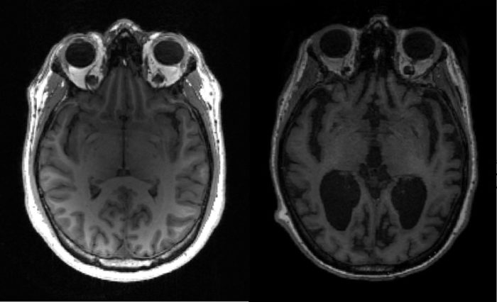Imagem de ressonância magnética de um cérebro saudável (e) e outro de um cérebro afetado pela doença de Alzheimer