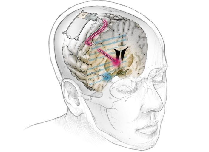 Pesquisadores conseguiram aliviar a depressão severa de uma paciente usando implante eletrônico no cérebro que atua como um “marca-passo” neural