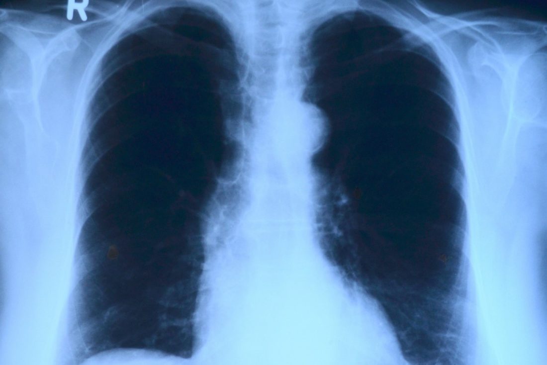 Nova tecnologia utiliza gás xenônio em ressonância magnética para descobrir lesões ocultas do pulmão
