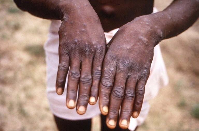 Marcas na pele provocadas por varíola do macaco em paciente em fase de recuperação, em foto de arquivo de 1997, na República Democrática do Congo