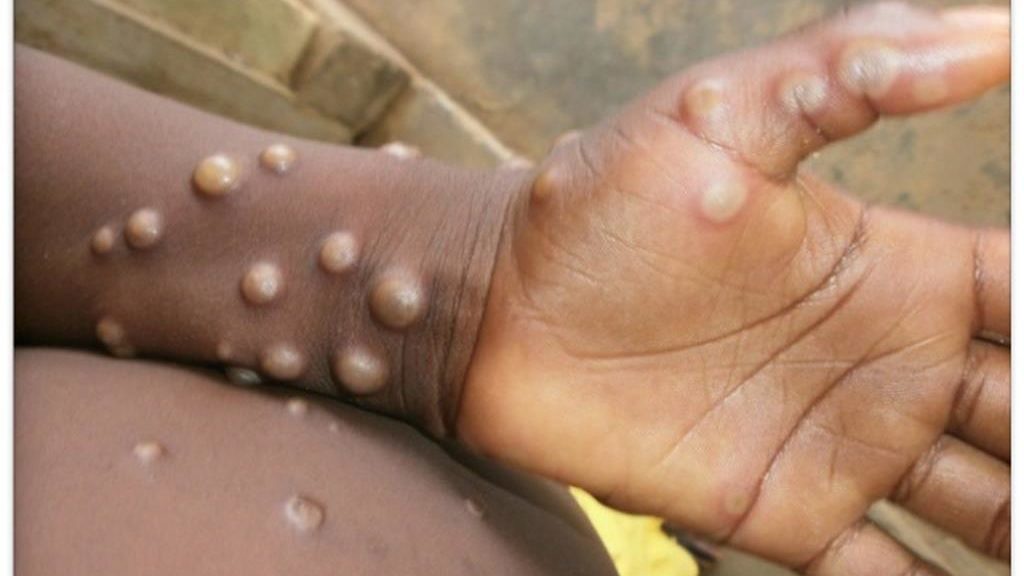 Surto de varíola do macaco está atingindo pessoas ao redor do mundo