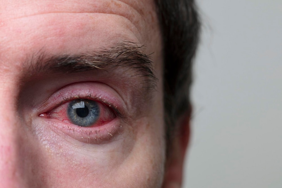 O H.Olhos identificou o primeiro caso de paciente com confirmação para a doença a partir de exame de coleta ocular