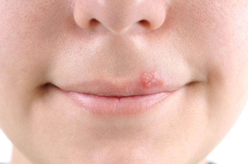 A herpes é caracterizada pelo surgimento de bolhas pequenas e doloridas nos lábios, gengivas, língua, céu da boca e até no nariz, rosto, queixo e pescoço.