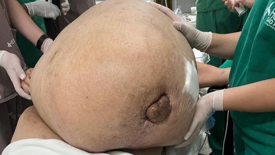 A paciente tem 45 anos, 1,53 metros de altura e estava pensando 150 kg. Ela deu entrada na unidade sentindo falta de ar por conta da tumoração.