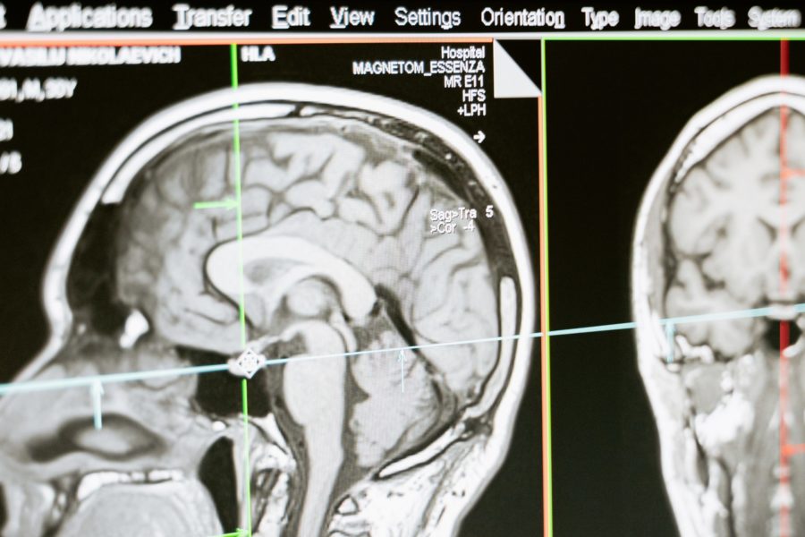 Estudo mostrou mudanças físicas na estrutura dos cérebros